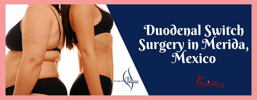 Duodenal Switch Surgery in Merida, Mexico